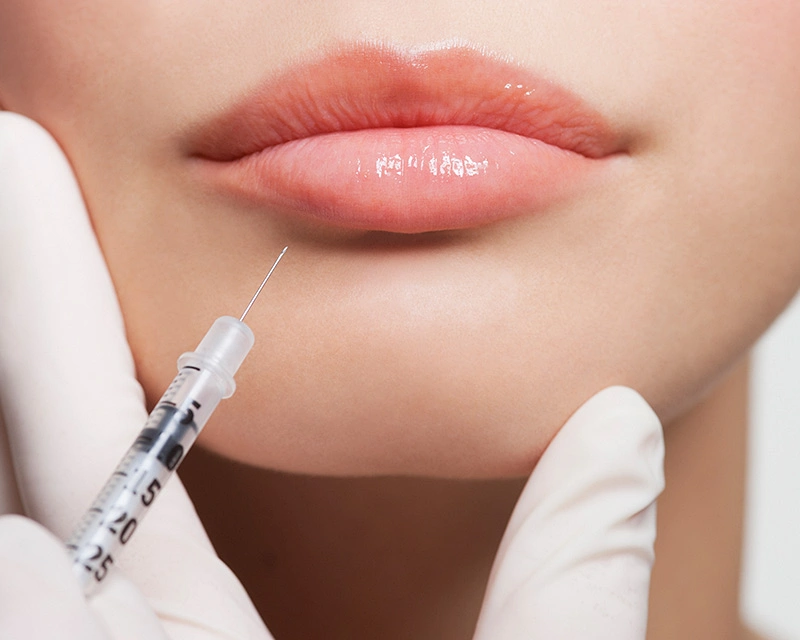 Datailaufnahme von Lippen mit Hyaluronspritze