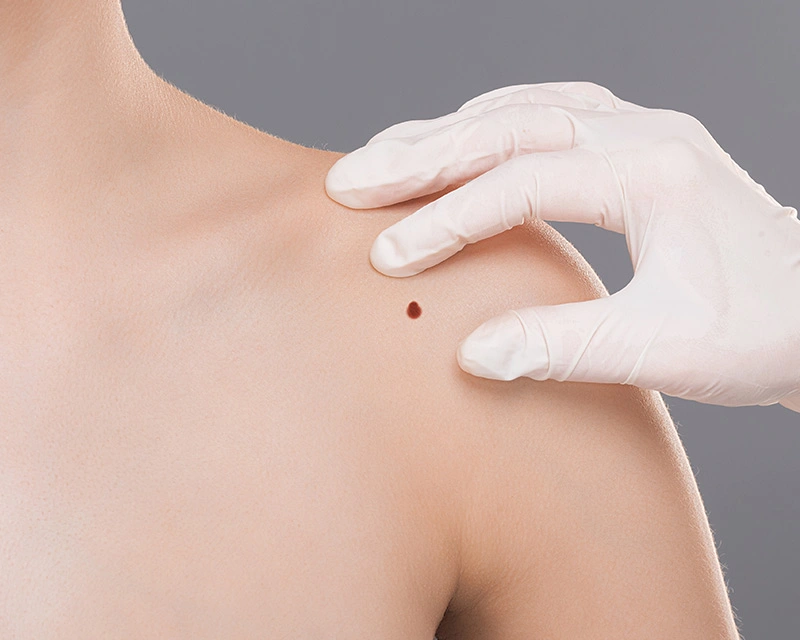 Detailaufnahme Muttermal an der Schulter