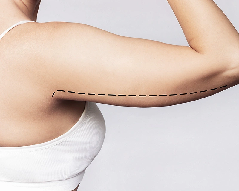 Cropped Shot einer jungen Frau mit überschüssigem Fett am Oberarm mit Markierungen zur Fettabsaugung