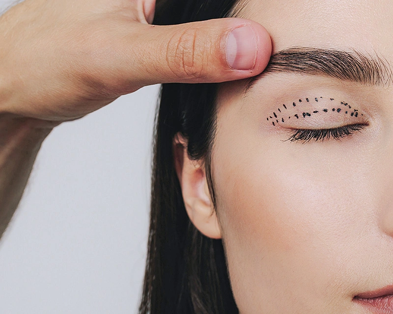 Markierung der Blepharoplastik. Anheben der Augenlider mit präziser Planung.